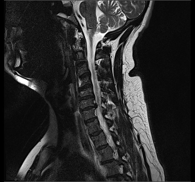 File:MRI C6 C7 disc herniation cevical.jpg